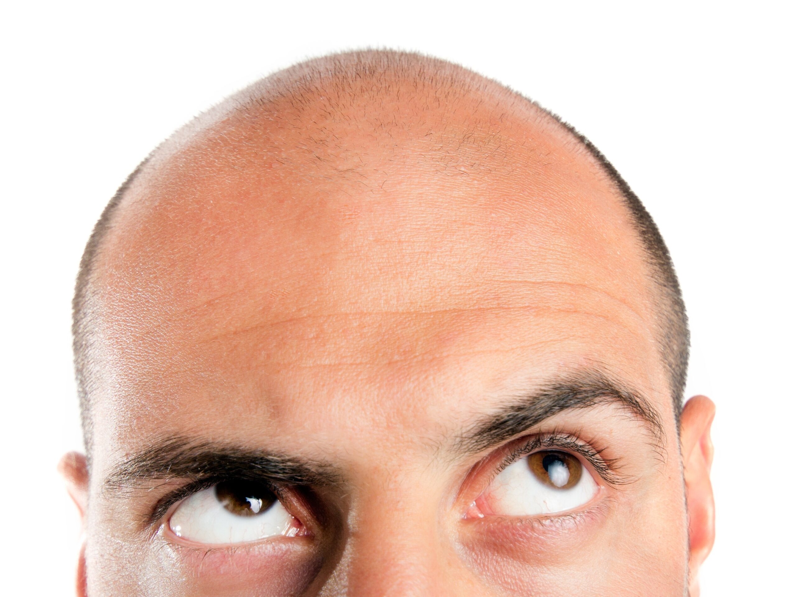 The Real Reasons Men Go Bald and What You Can Do About It